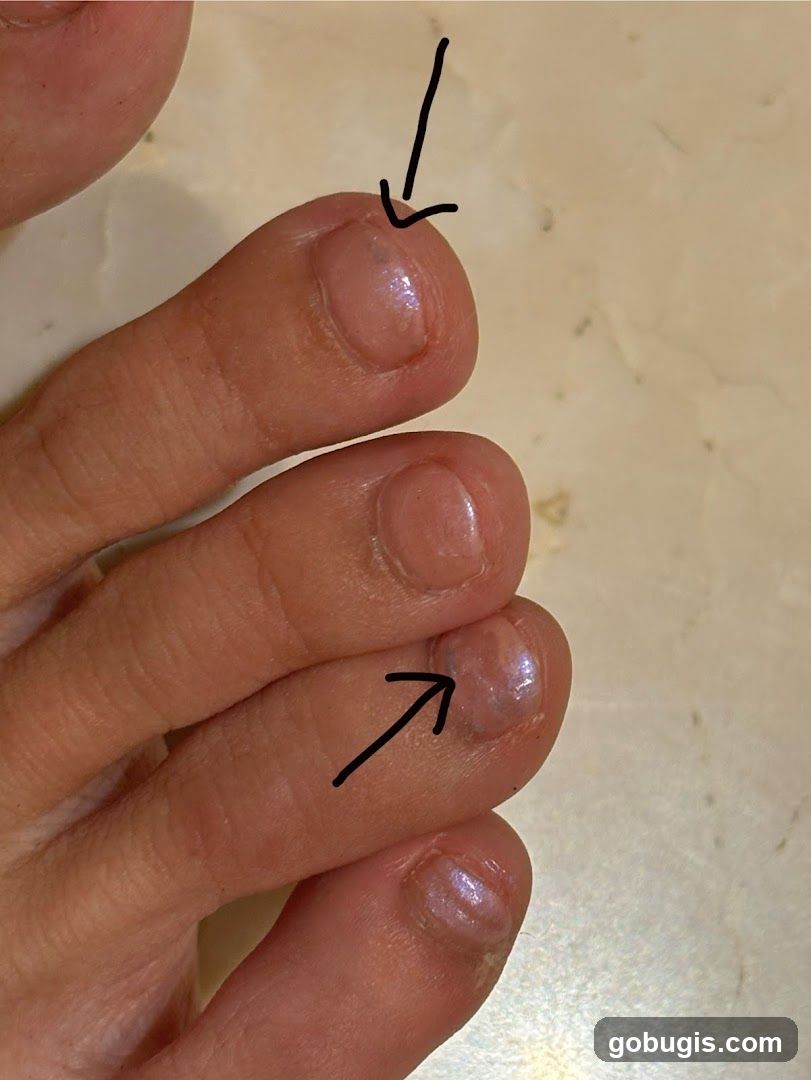 Toenail discoloration