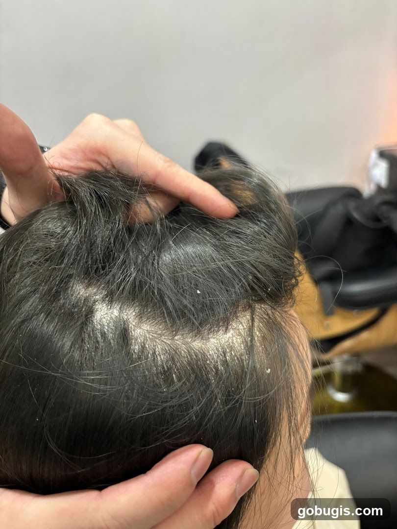 Dandruff on scalp