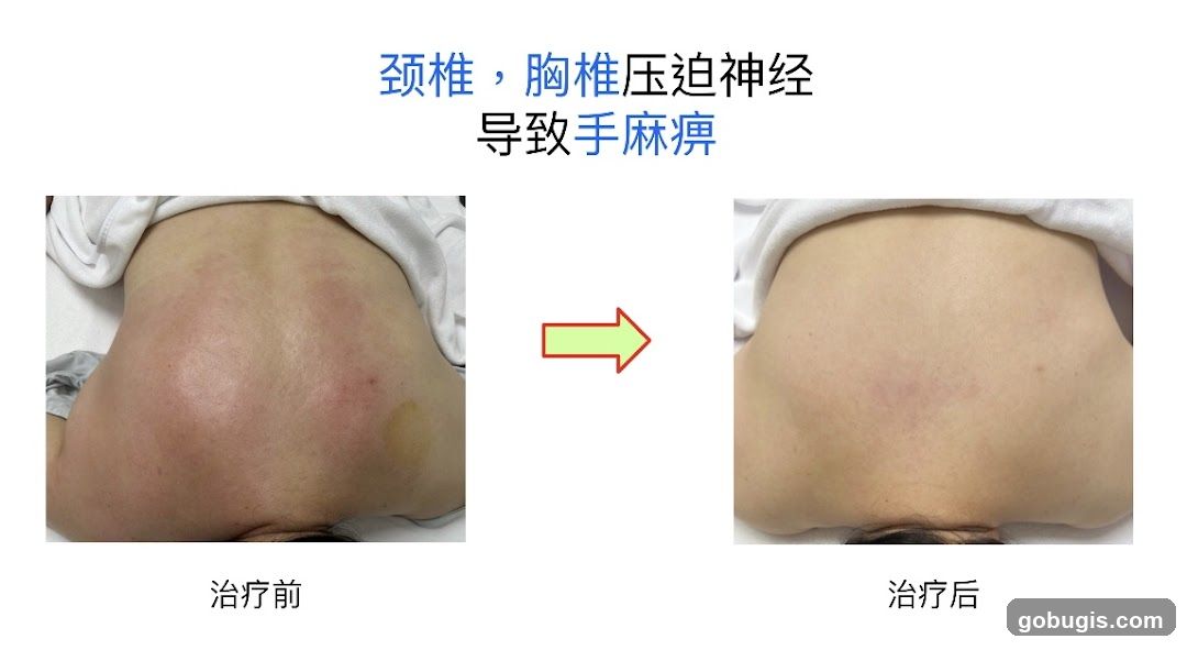 Before and After Treatment of Cervical and Thoracic Spine Nerve Compression